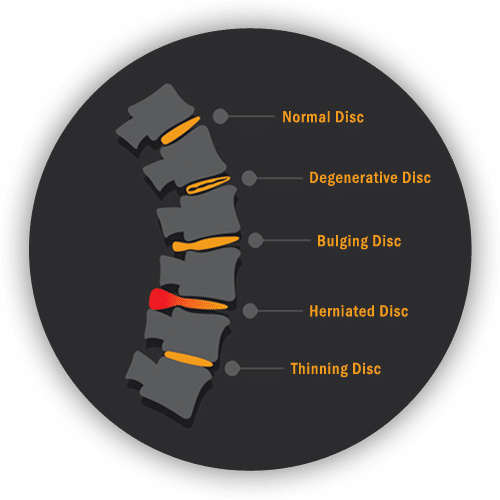 back pain spine graphic